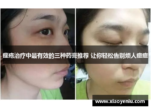 痤疮治疗中最有效的三种药膏推荐 让你轻松告别烦人痘痘