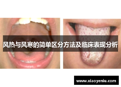风热与风寒的简单区分方法及临床表现分析